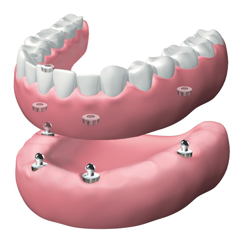 Dentadura extraíble