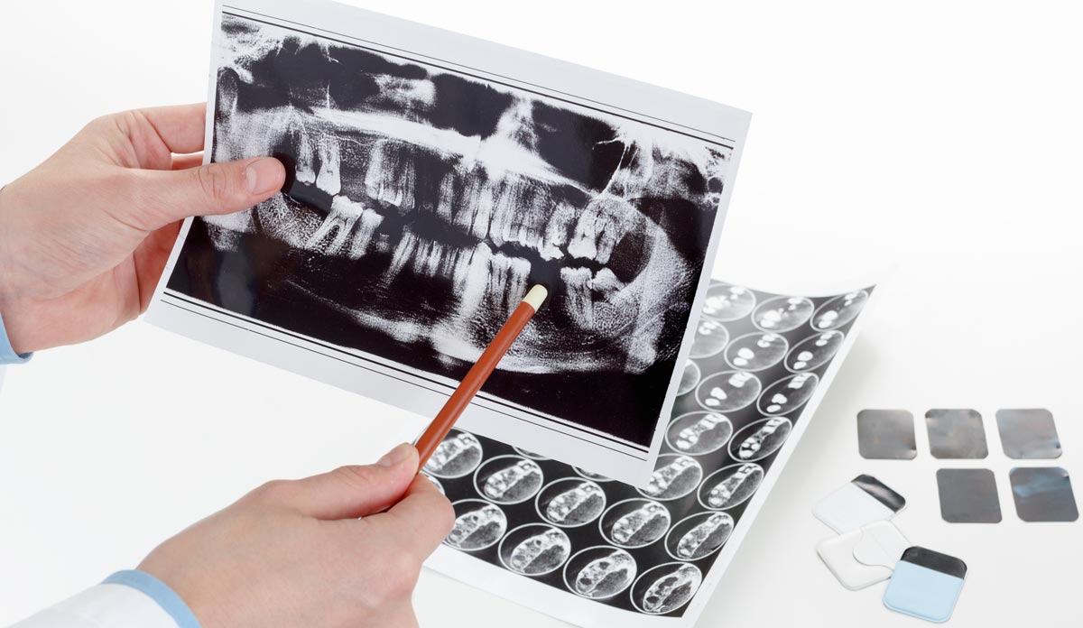 Implantes y cirugía oral